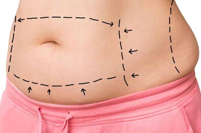 Abdominoplasty