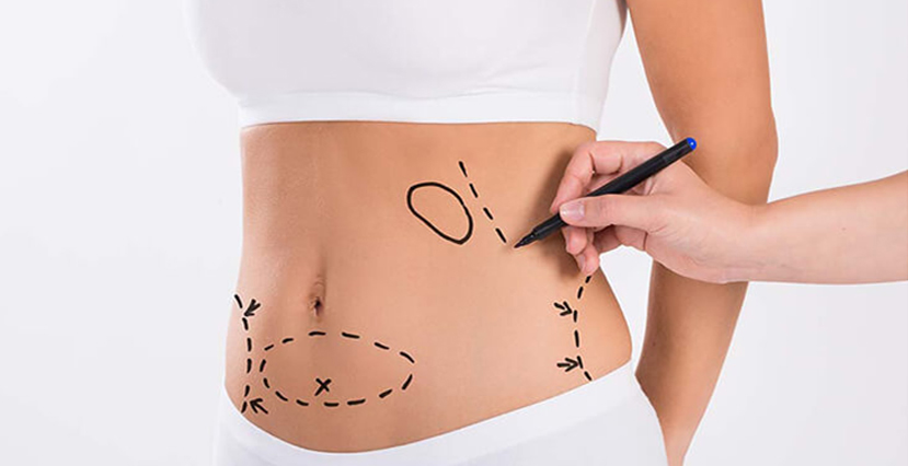 Abdominoplasty/Lipoabdominoplasty