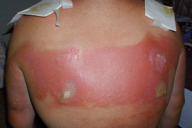 Acute_Burn_and_Their_After_Effects