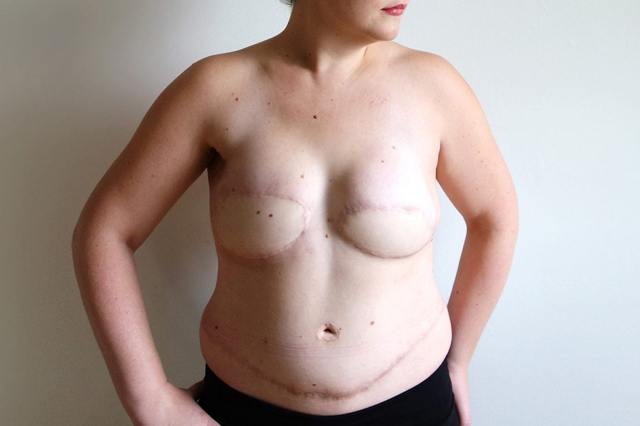Flap_Surgery