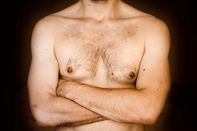 Male_Breast_Correction