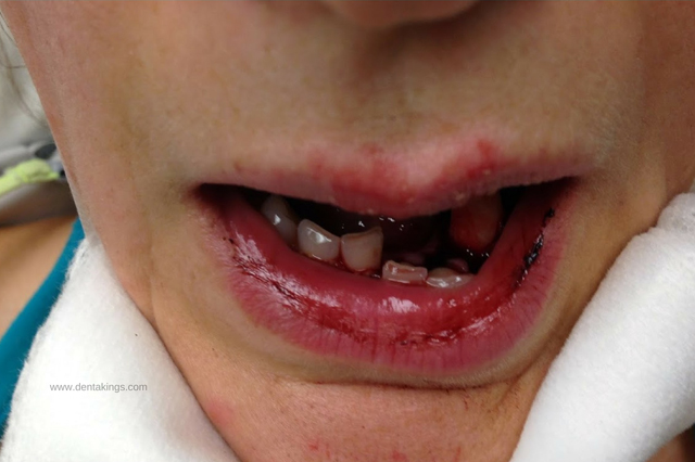 Maxillofacial_Injuries_Repair
