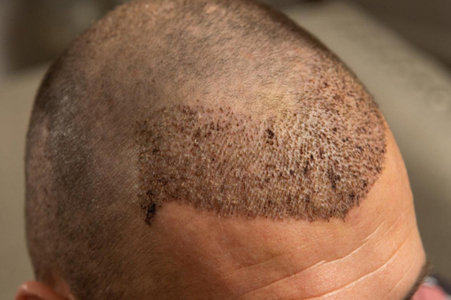 Natural_Hair_Transplant