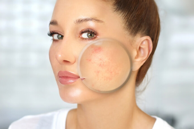 Skin_Grafting