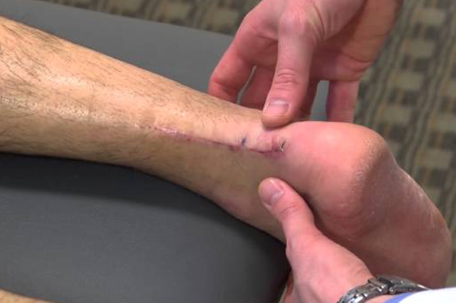 Tendon_Injuries