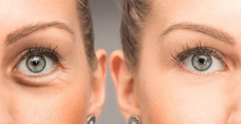 Eyelid Bags Correction