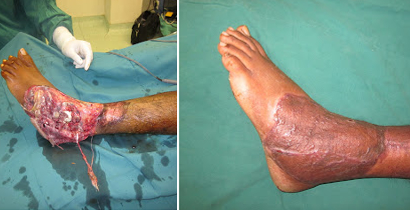 Flap Surgery