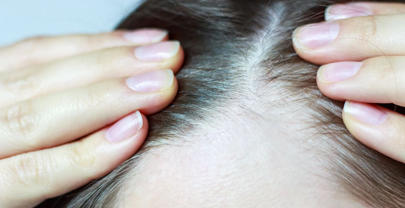 Hair Fall Treatment