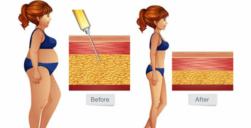 Liposuction
