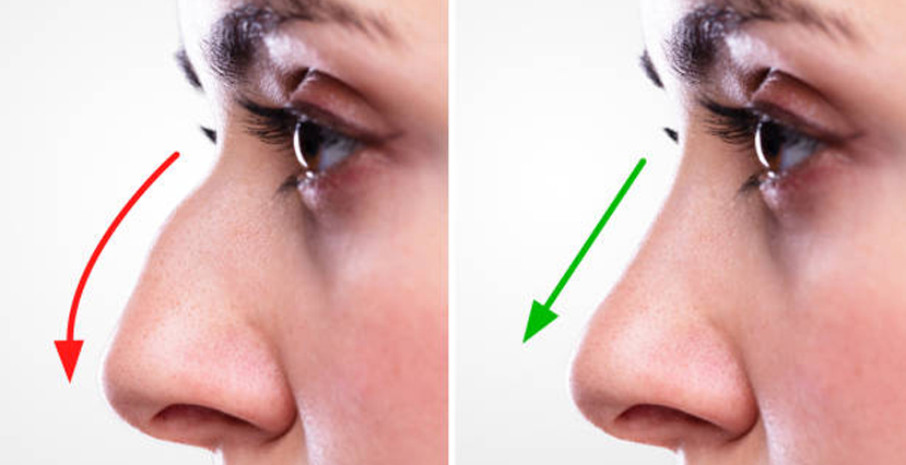 Nose Reshaping