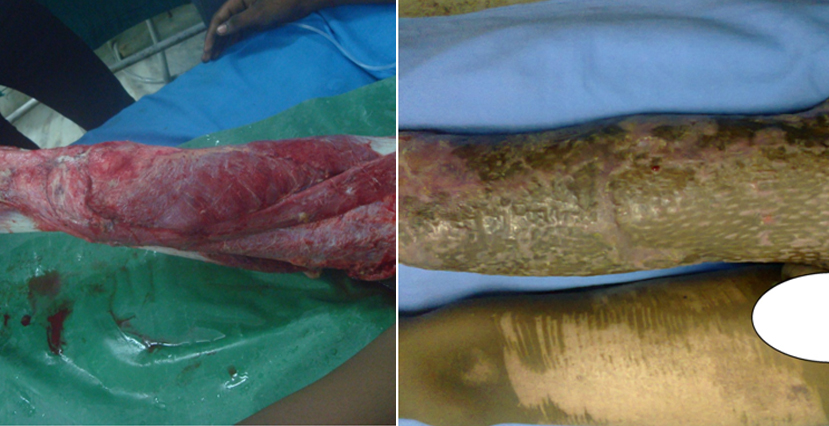 skin grafting